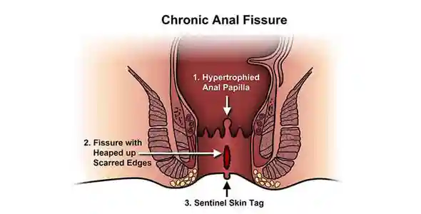 Anal Fissure Diagram