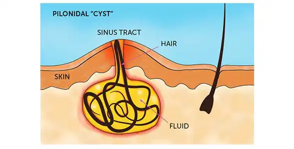 Pilonidal Sinus Diagram